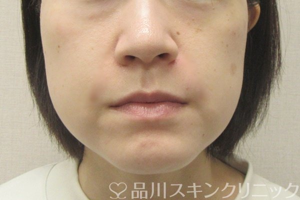 症例NO.69276のAFTER写真