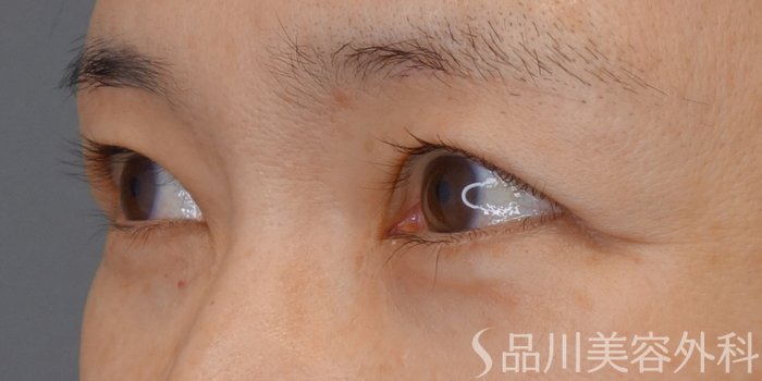 症例NO.72104のBEFORE写真