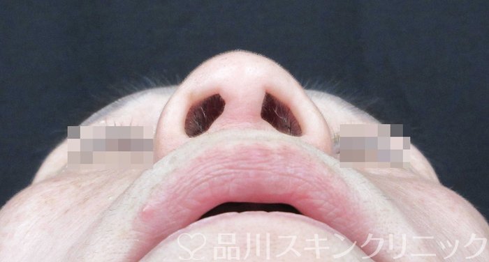 症例NO.65370のBEFORE写真