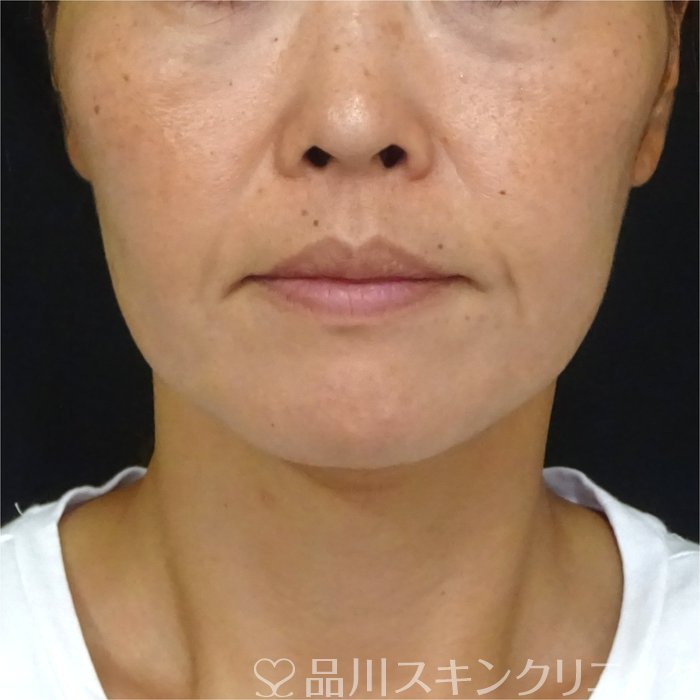 症例NO.71656のBEFORE写真