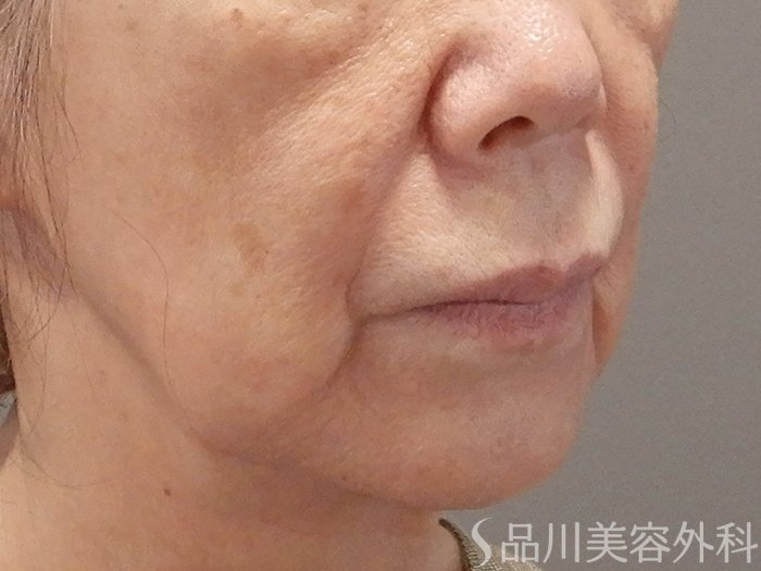 症例NO.71712のBEFORE写真
