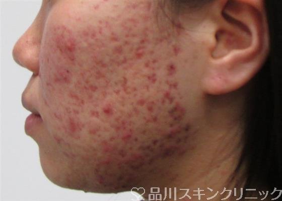 症例NO.42869のBEFORE写真