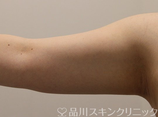症例NO.70474のAFTER写真