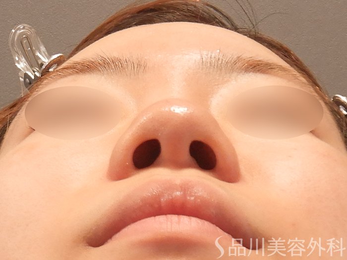 症例NO.70397のBEFORE写真