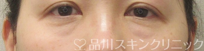 症例NO.71660のBEFORE写真
