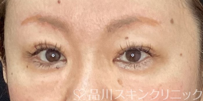 症例NO.70439のAFTER写真