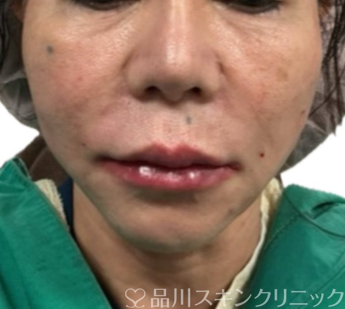 症例NO.71155のAFTER写真