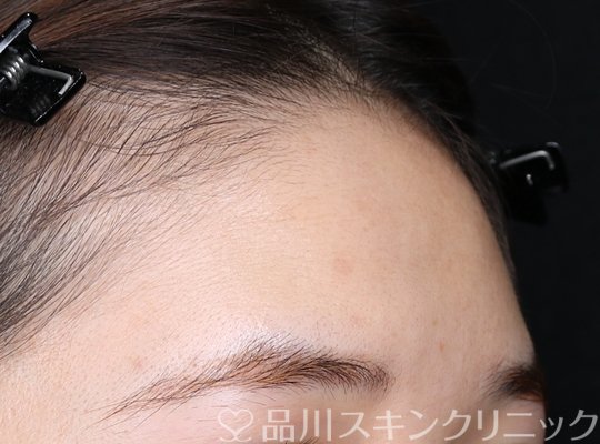 症例NO.71275のBEFORE写真