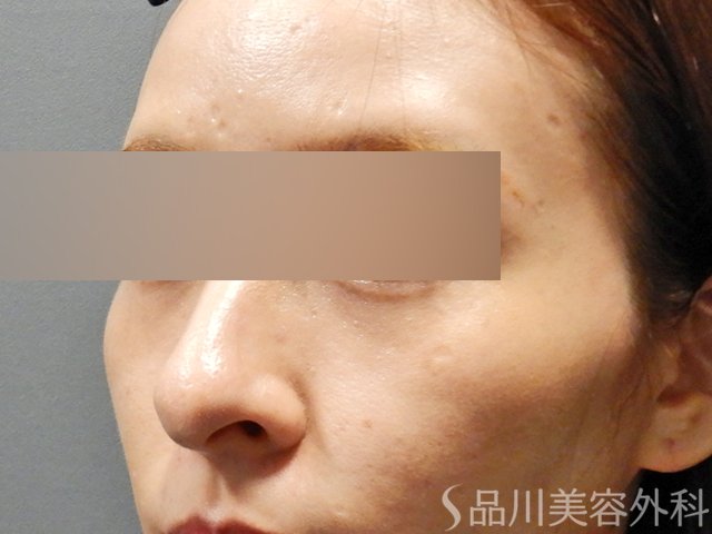 症例NO.67974のBEFORE写真