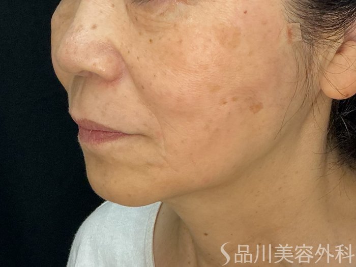 症例NO.71865のAFTER写真