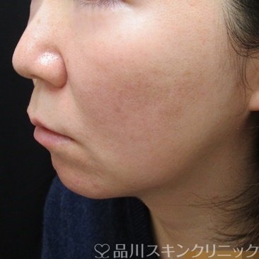 症例NO.69982のBEFORE写真