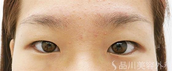 症例NO.25020のBEFORE写真