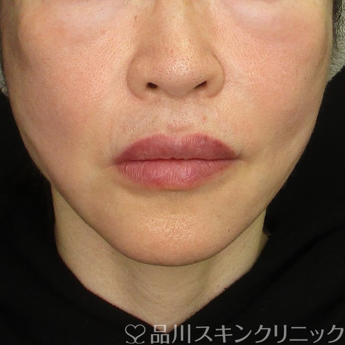 症例NO.70270のAFTER写真