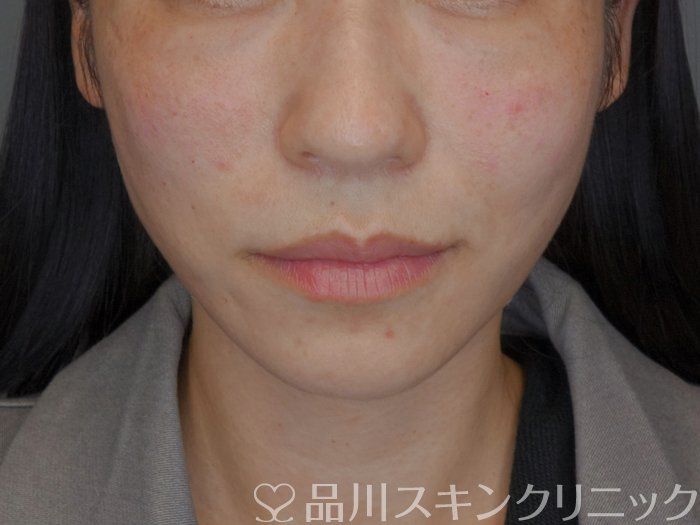 症例NO.74961のAFTER写真