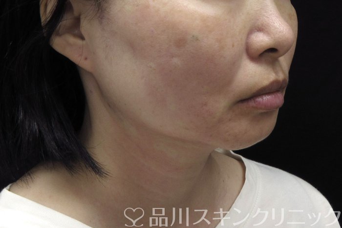 症例NO.74421のAFTER写真