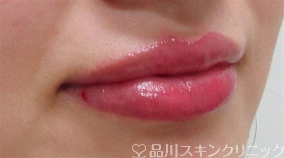 症例NO.31539のAFTER写真