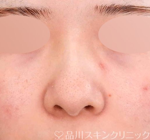 症例NO.62702のBEFORE写真