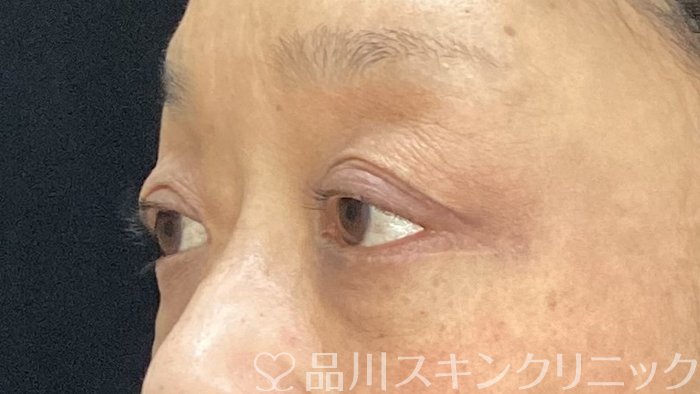 症例NO.71421のAFTER写真