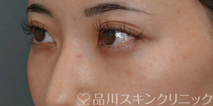 症例NO.74048のBEFORE写真