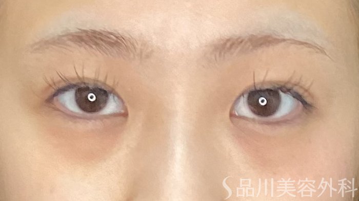 症例NO.71360のAFTER写真