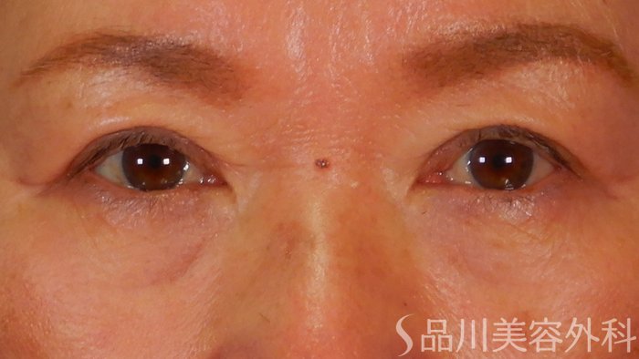 症例NO.69584のAFTER写真