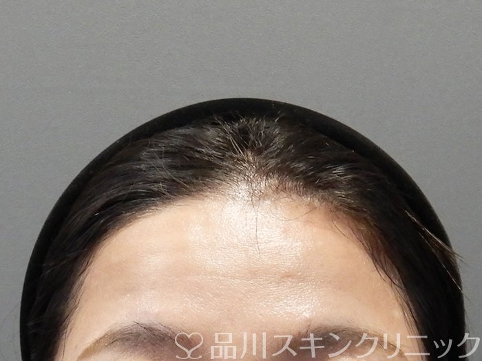 症例NO.75258のBEFORE写真