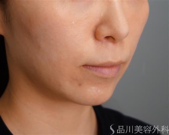 症例NO.51728のBEFORE写真