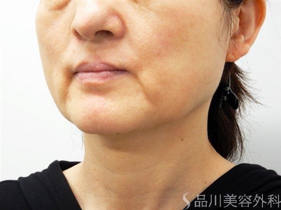 症例NO.53453のBEFORE写真