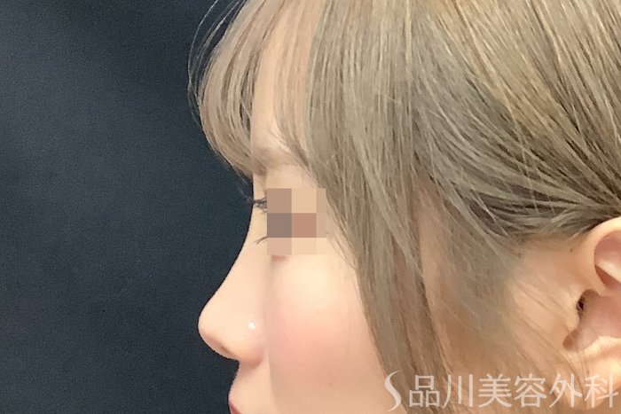 症例NO.71637のAFTER写真