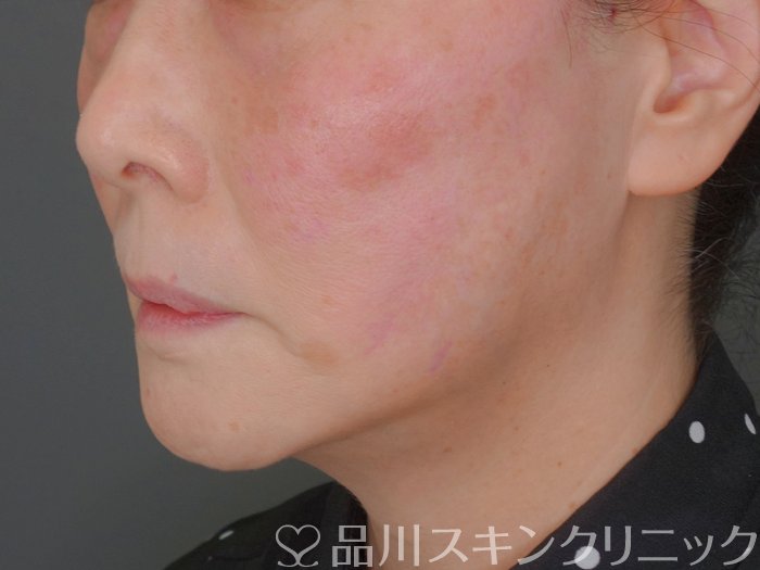 症例NO.73049のAFTER写真