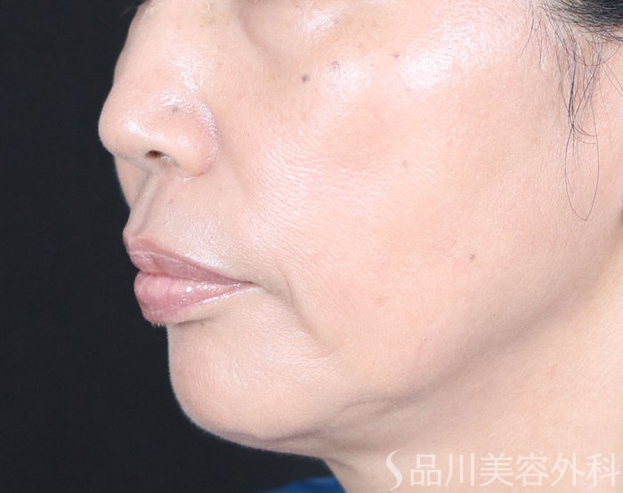 症例NO.72107のAFTER写真