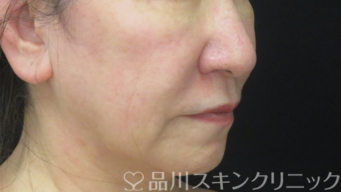 症例NO.71887のBEFORE写真