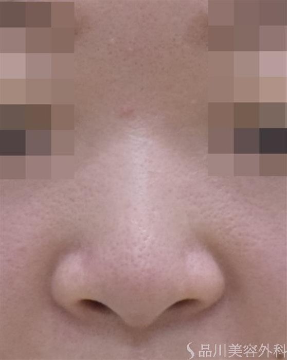 症例NO.48541のBEFORE写真