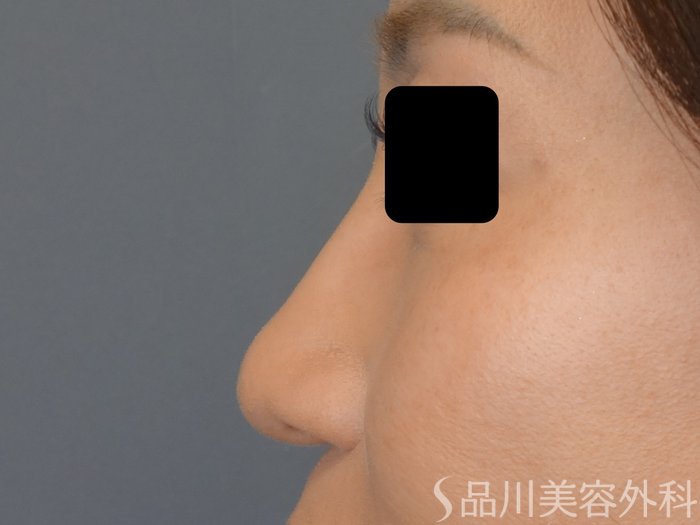 症例NO.69357のBEFORE写真