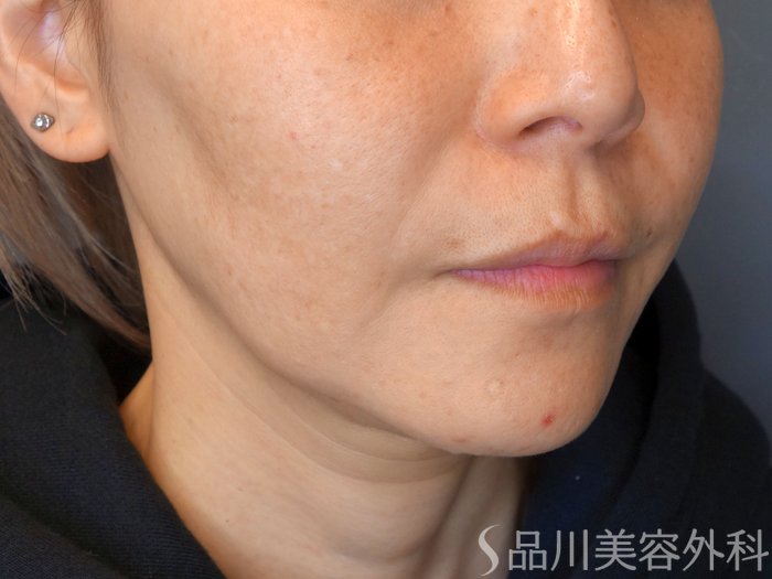 症例NO.67767のBEFORE写真