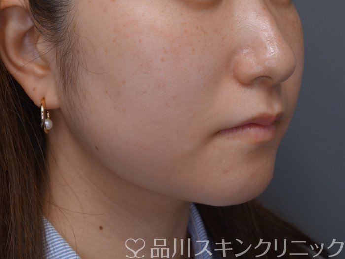 症例NO.75079のBEFORE写真