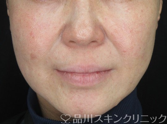 症例NO.70077のAFTER写真