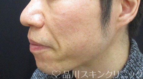 症例NO.69680のBEFORE写真
