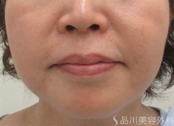 症例NO.19198のBEFORE写真
