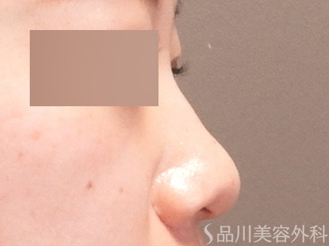 症例NO.70723のBEFORE写真