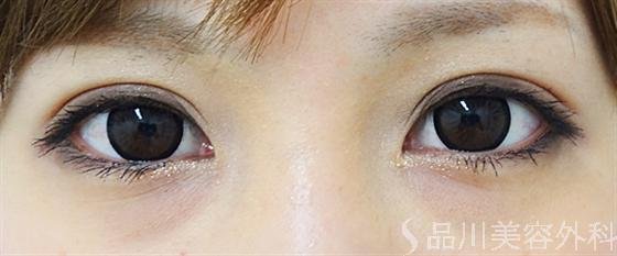 症例NO.14155のAFTER写真