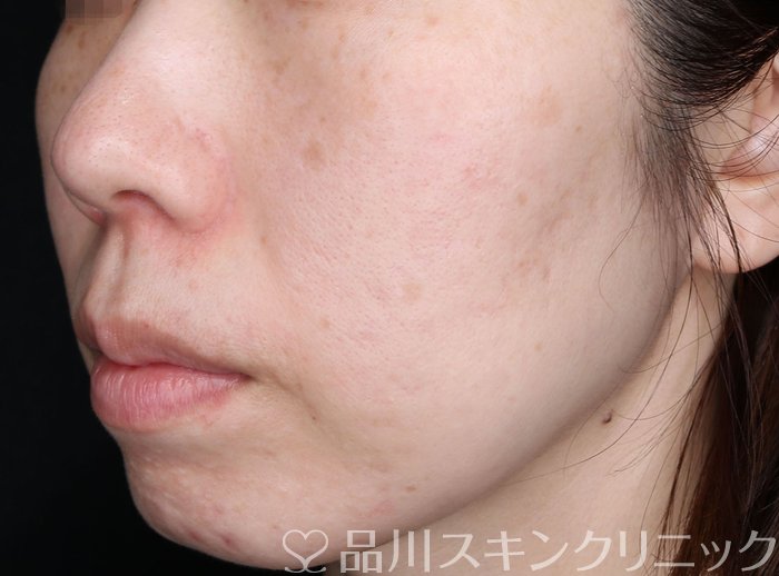 症例NO.69380のAFTER写真