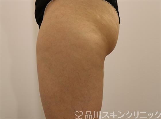 症例NO.42716のAFTER写真