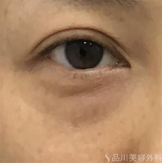症例NO.46614のBEFORE写真