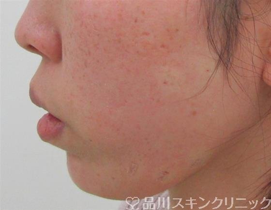 症例NO.34452のAFTER写真