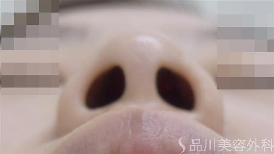 症例NO.46734のBEFORE写真
