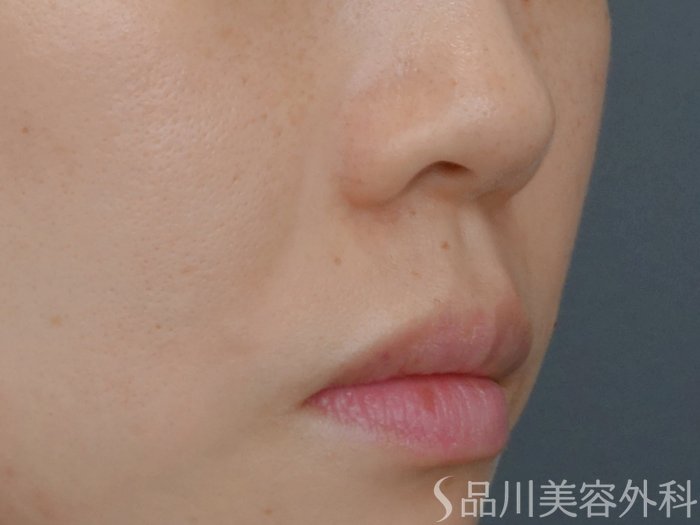 症例NO.71738のAFTER写真