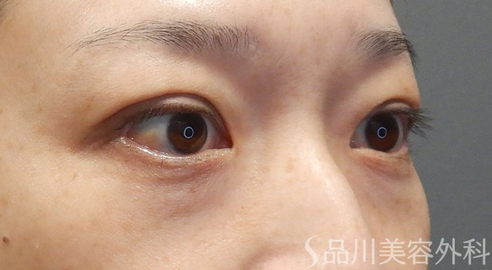 症例NO.72003のAFTER写真