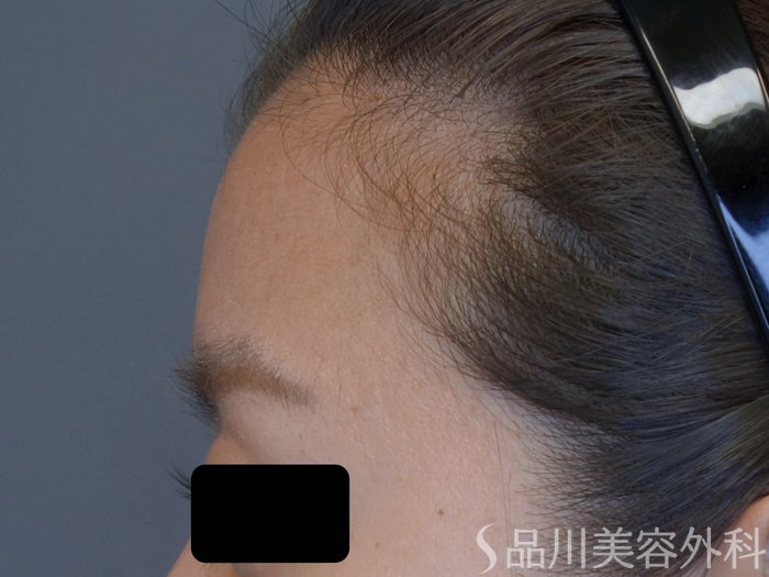症例NO.75345のBEFORE写真