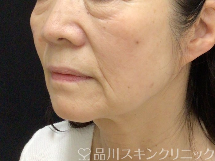 症例NO.69638のBEFORE写真